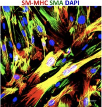 Progenitor cells in culture differentiate into smooth muscle cells identified by SM-MHC (red) and α-SMA (green) expression.