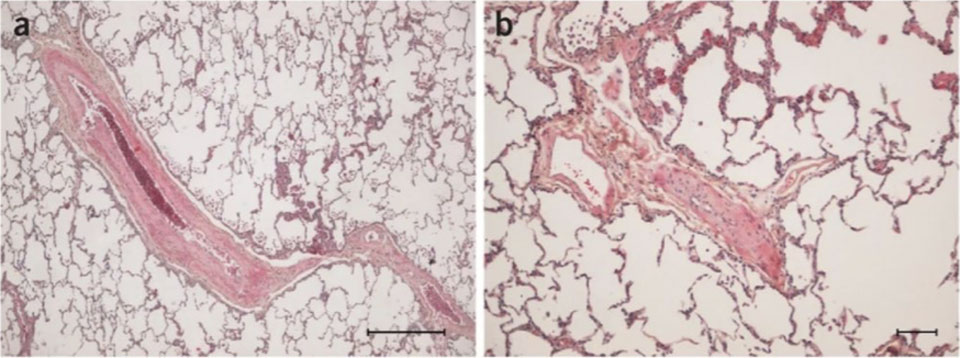 Pathology of heritable PVOD